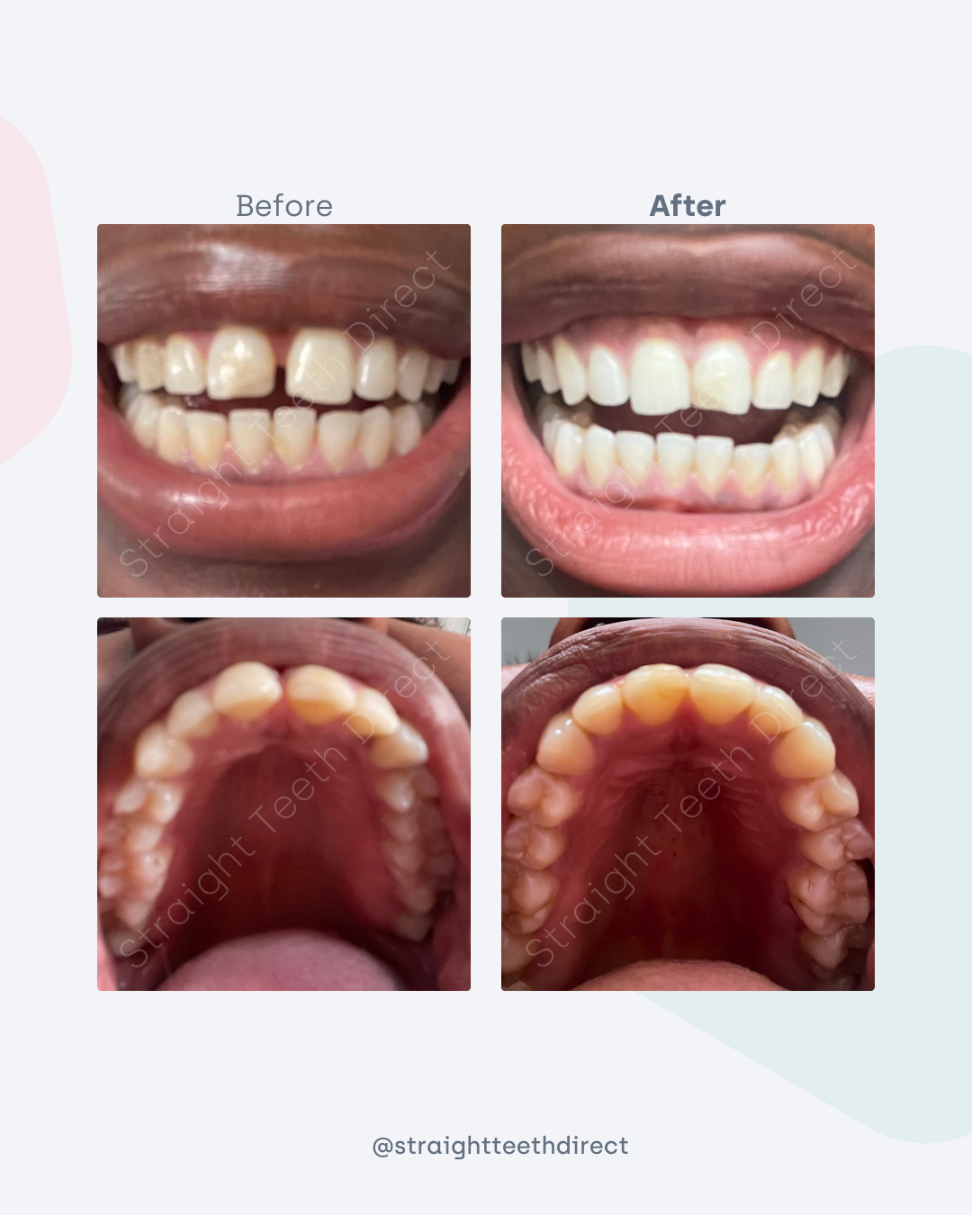 Before and after 1