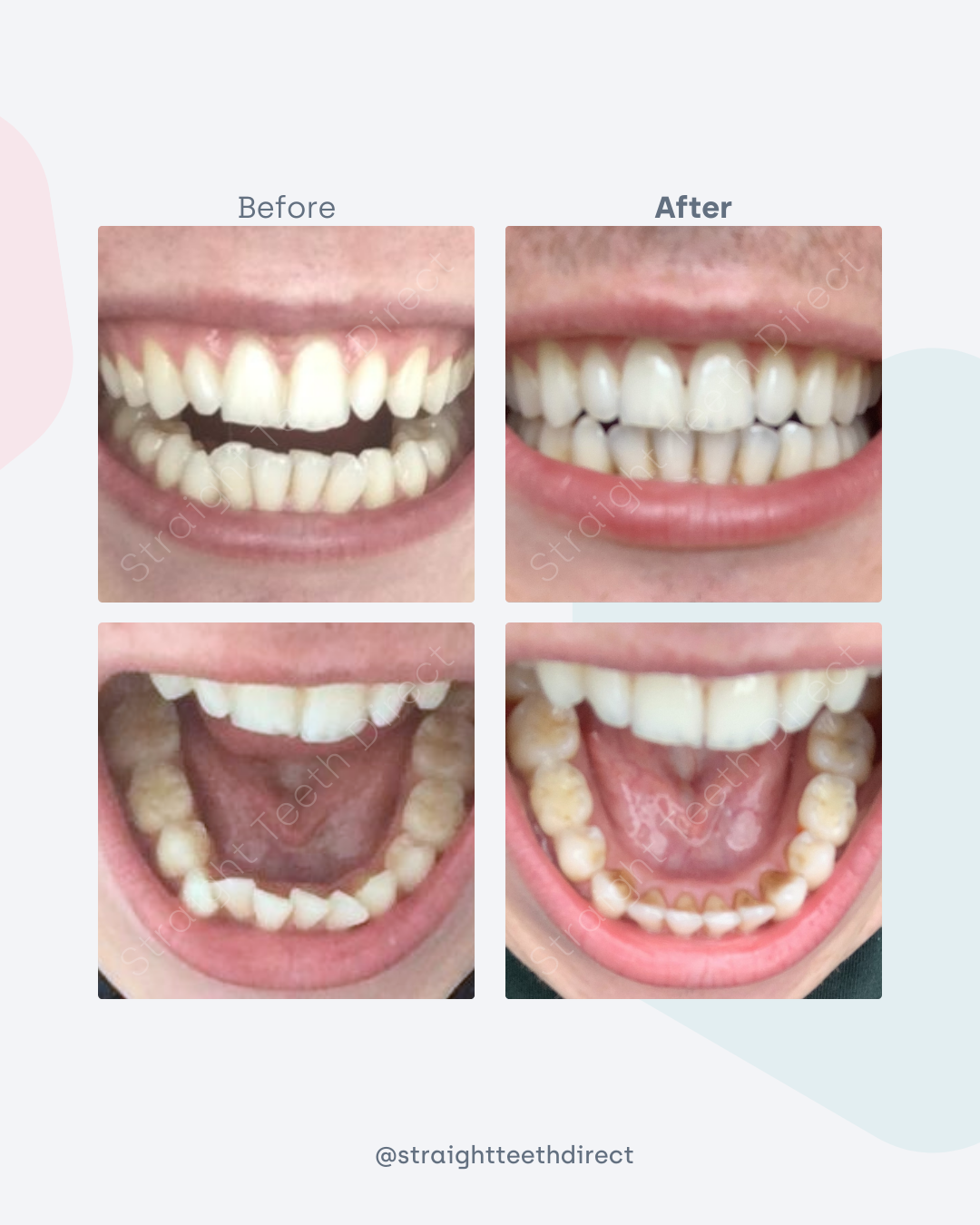 Before and after 2