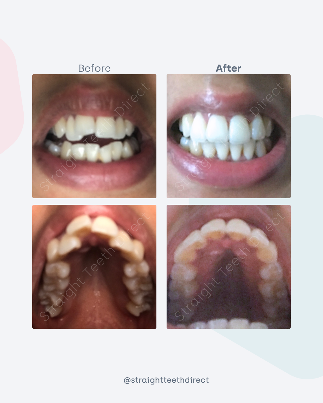 Before and after 4