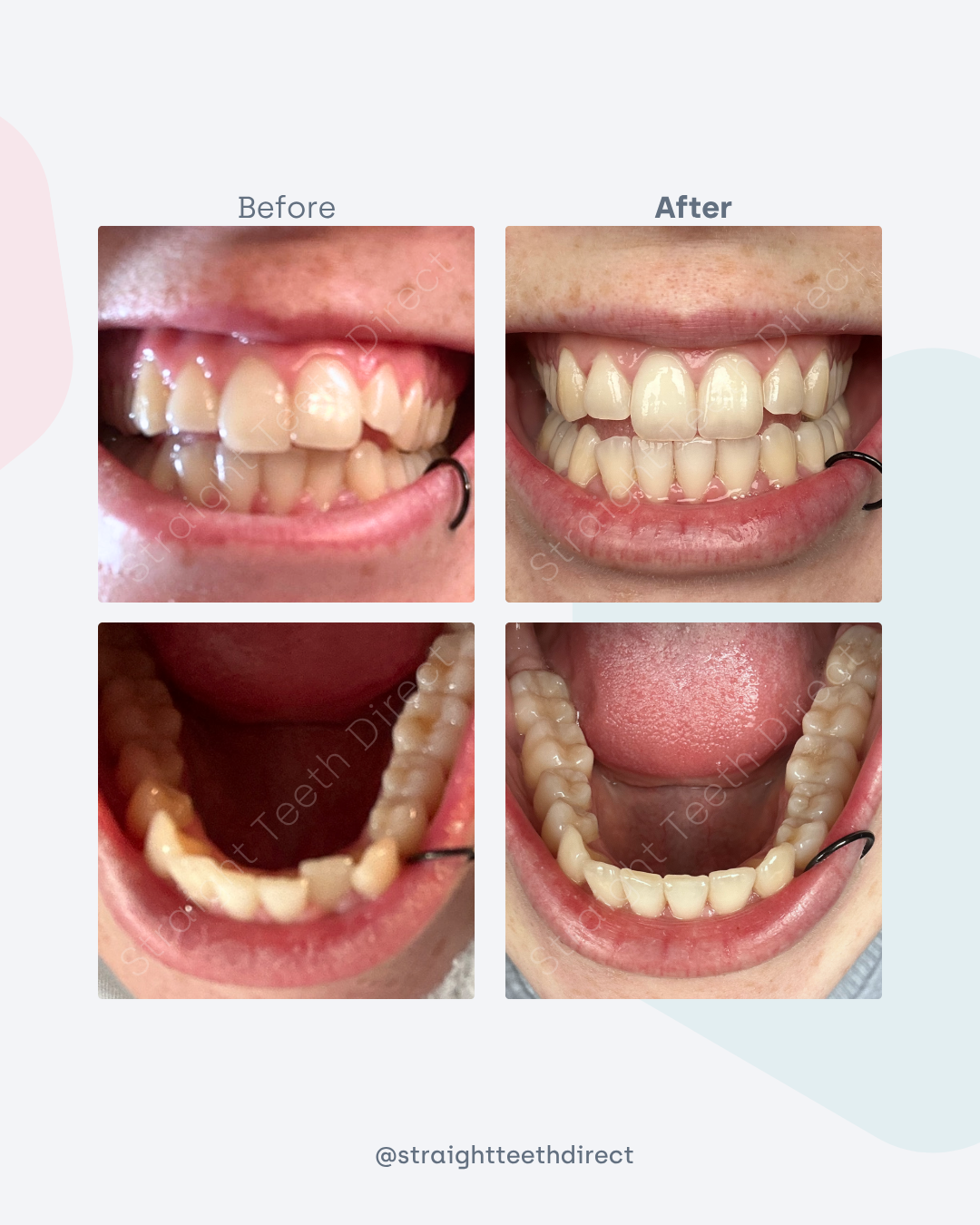 Before and after 5