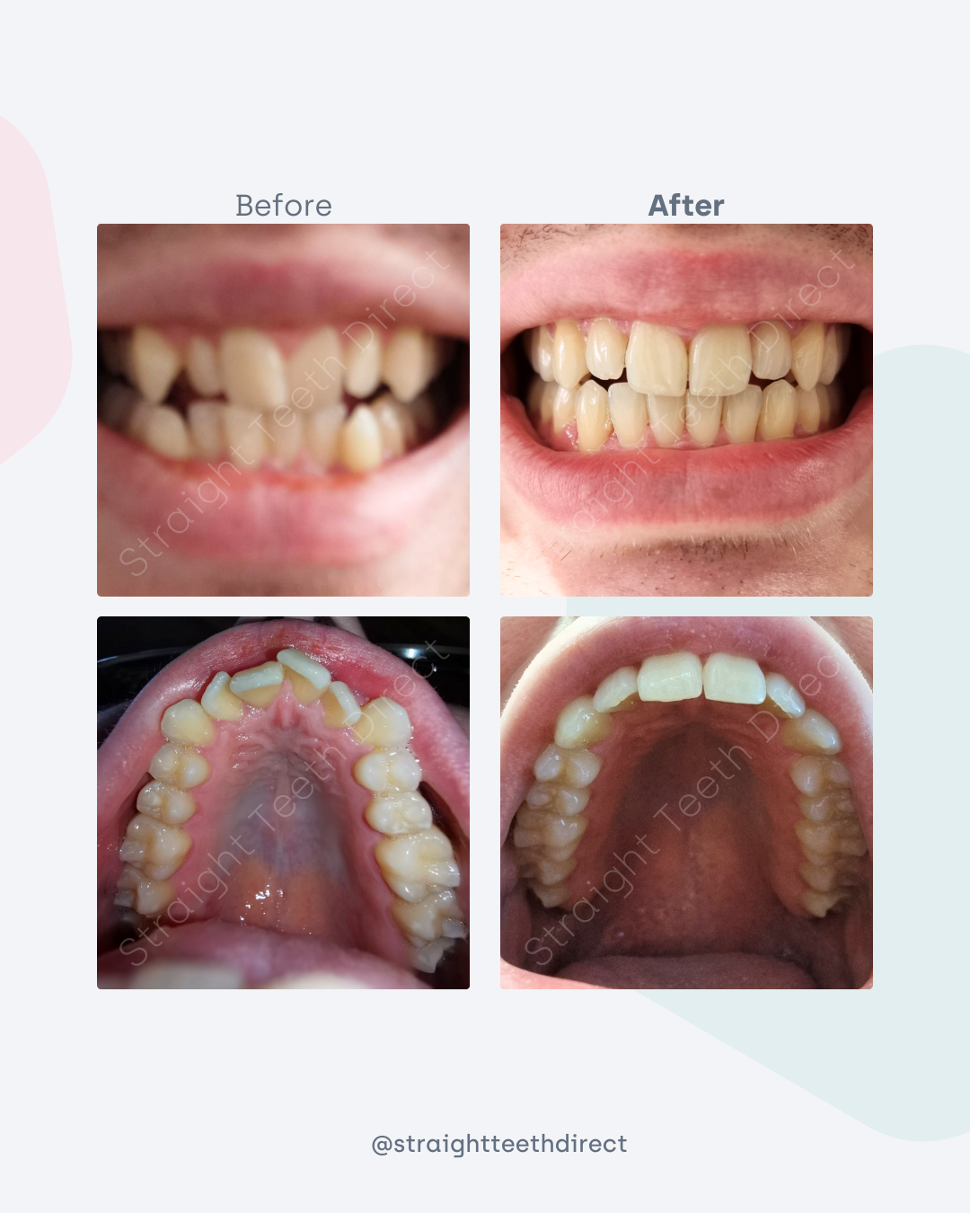 Before and after 6